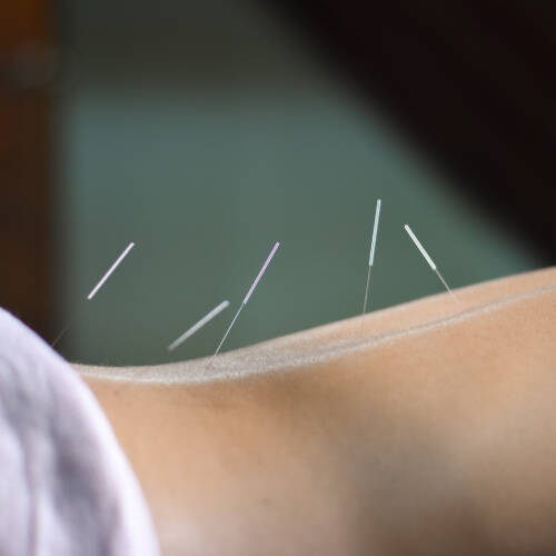 acupuntura